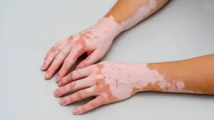 Un medicament pentru persoanele cu vitiligo a avut rezultate promițătoare într-un studiu clinic