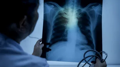 O boală antică revine în forță! Nici cele mai avansate antibiotice nu-i fac față