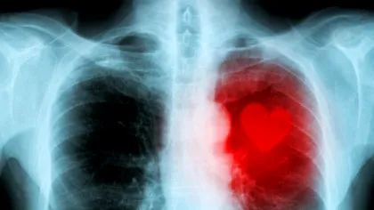 Boala cronică de rinichi otrăvește inimile pacienților, au descoperit oamenii de știință