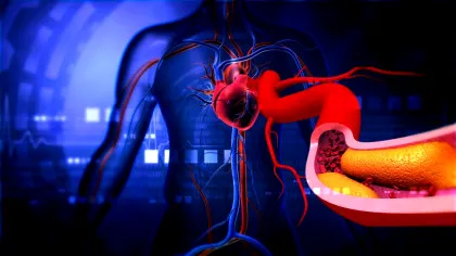 De ce colesterolul nu este doar „problema oamenilor supraponderali”?