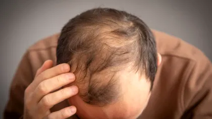 Oamenii de știință au descoperit o proteină care ar putea ajuta la inversarea căderii părului