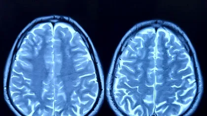 Depresia ar putea afecta capacitatea creierului de a genera noi neuroni