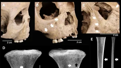 Dinții copiilor antici dezvăluie o boală extrem de gravă de acum 4.000 de ani