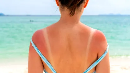 O singură arsură solară intensă îți poate schimba sănătatea pentru totdeauna