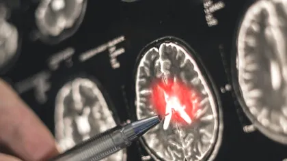 Scleroza laterală amiotrofică, boala care oprește corpul dar lasă mintea prizonieră