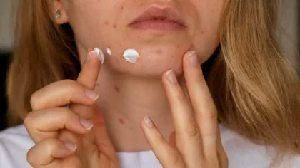 Un tratament comun pentru acnee a fost asociat cu un risc de schizofrenie cu 30% mai mic