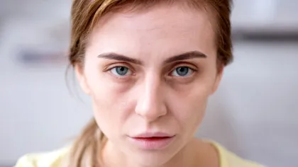 „Ferritin face”, noul termen viral de pe rețelele sociale. Ce legătură are cu deficitul de fier