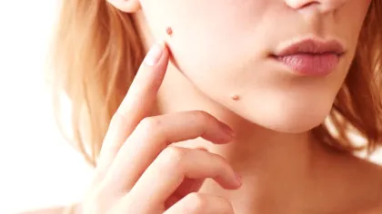 Test de cultură generală. De ce apar alunițele?