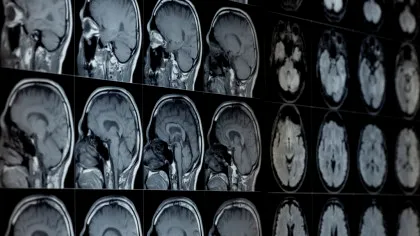 Speranța de viață ar putea fi aflată pe baza vârstei biologice a creierului