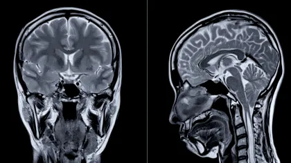 Ce s-a întâmplat după ce o femeie a auzit voci care îi spuneau că are o tumoare pe creier?