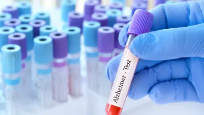 Un test simplu de sânge ar putea depista Alzheimer înainte de pierderea memoriei