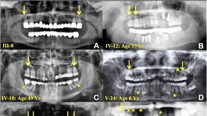 A fost descoperită cauza pentru o mutație genetică misterioasă
