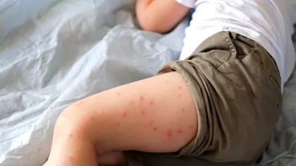 România este campioană absolută la cazurile de rujeolă din Europa