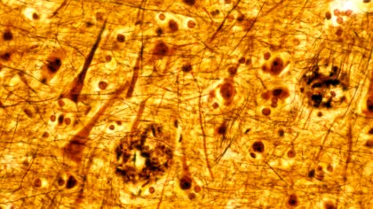 Cercetătorii au reușit să inverseze boala Alzheimer cu „medicamente supramoleculare”