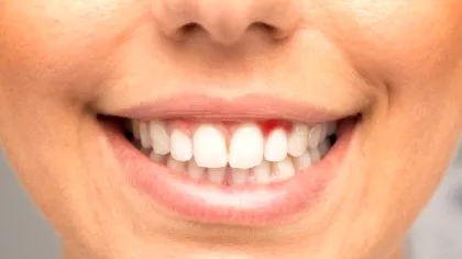 Sângerarea gingiilor ar putea fi un semn precoce al unei afecțiuni mult mai grave
