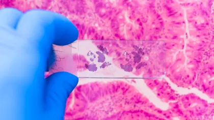 Cercetătorii canadieni anunță o descoperire majoră în lupta împotriva cancerului