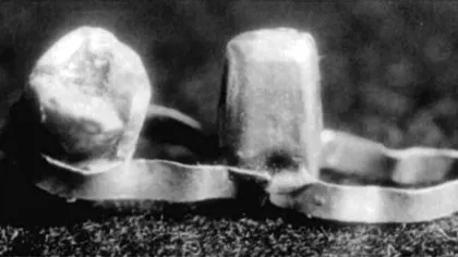 Aparatele dentare nu sunt atât de vechi pe cât s-ar crede