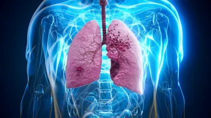 A fost aprobat primul tratament pentru o boală pulmonară gravă