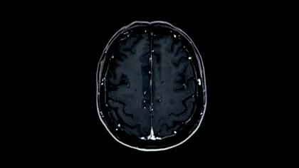 Un test de sânge îi poate ajuta pe medici să identifice mai bine severitatea leziunilor cerebrale