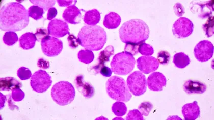 Formele agresive de cancer ar putea fi oprite de un vaccin experimental